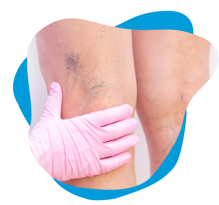 tratamento-varizes-cirurgiao-vascular-rio-de-janeiro