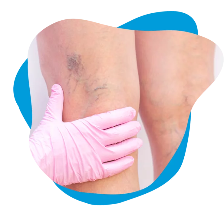tratamento-varizes-cirurgiao-vascular-rio-de-janeiro